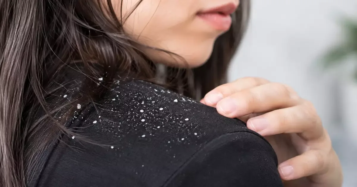 Coceira e descamação no couro cabeludo podem exigir avaliação dermatológica