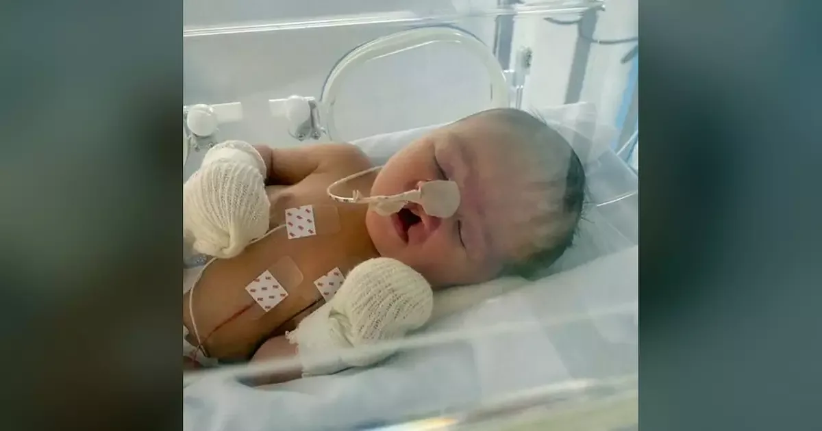 Campanha busca R$ 30 mil para cirurgia de Elizabeth, que nasceu com fissura labial