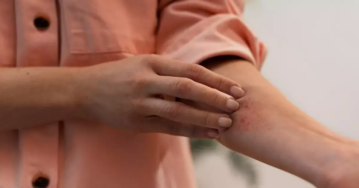 Coceira e lesões recorrentes exigem atenção para dermatite atópica