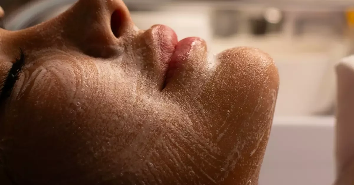 Isotretinoína para estética não tem indicação formal e mantém riscos