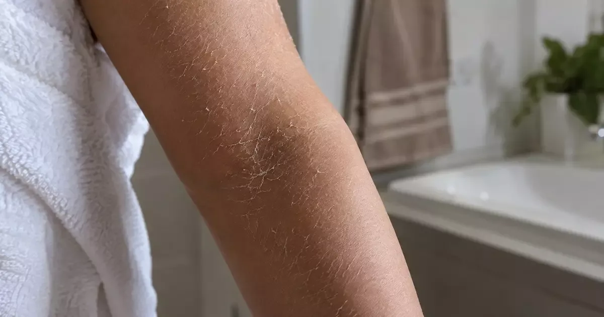Hidratante corporal funciona melhor quando a pele ainda está úmida