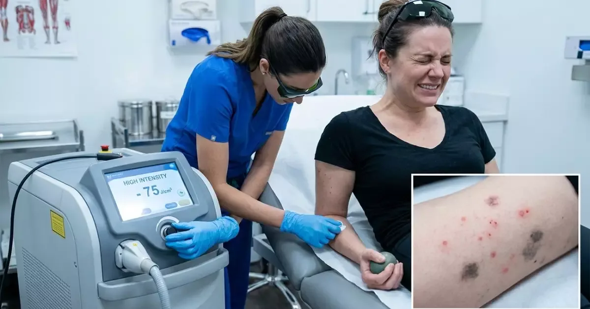 Queimaduras após depilação a laser podem gerar tratamento e indenização